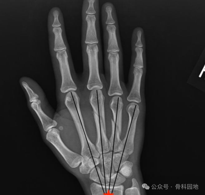 antegrade intramedullary screw fixation for metacarpal fractures a novel technique-3