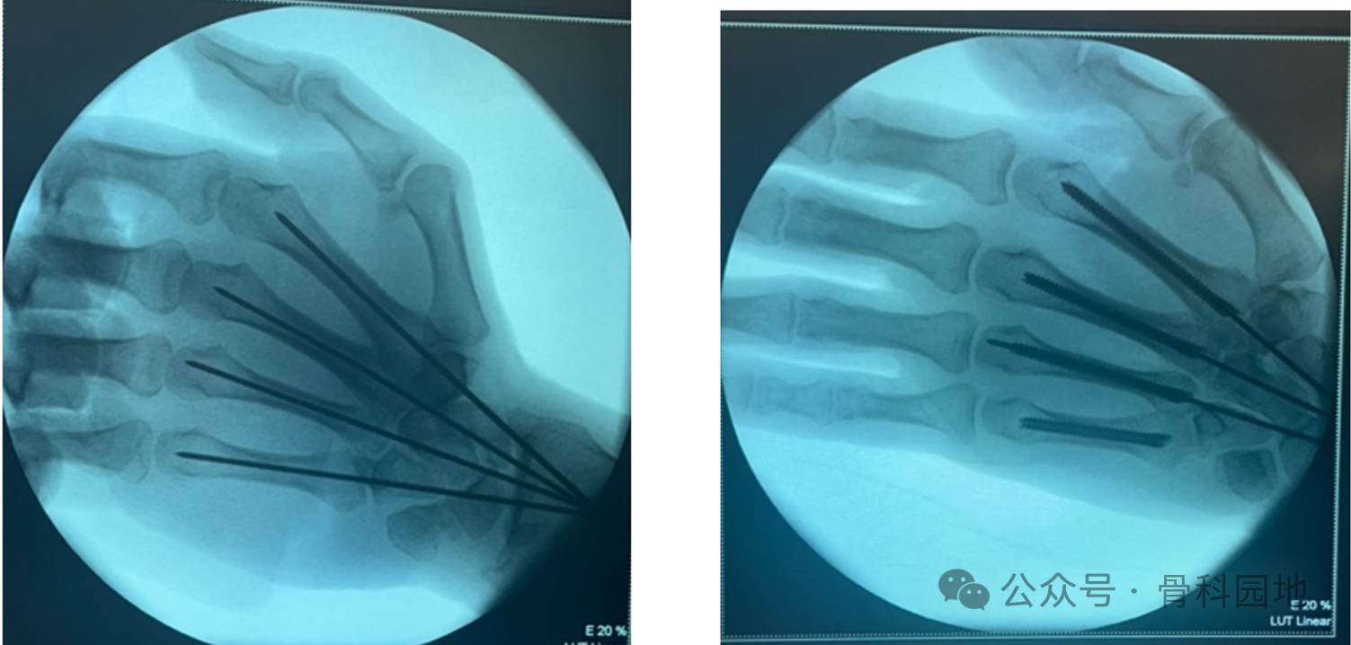 antegrade intramedullary screw fixation for metacarpal fractures a novel technique-1