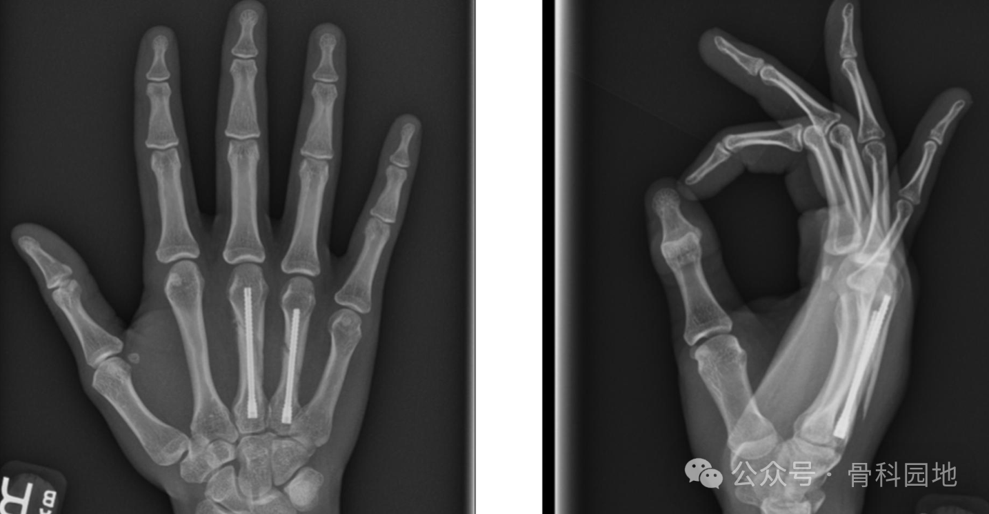 Antegrade Intramedullary Screw Fixation for Metacarpal Fractures: A Novel Technique