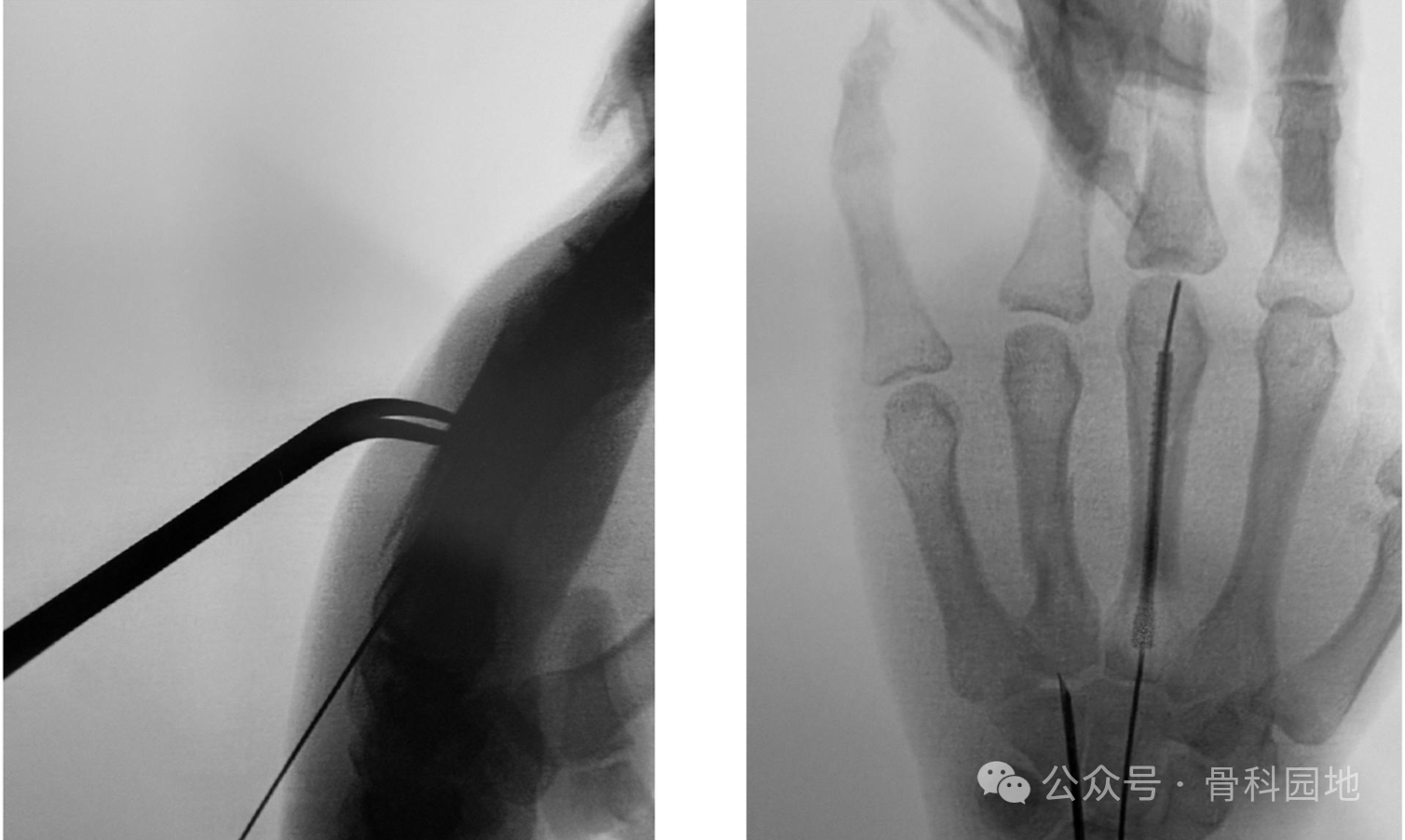 antegrade intramedullary screw fixation for metacarpal fractures a novel technique-4