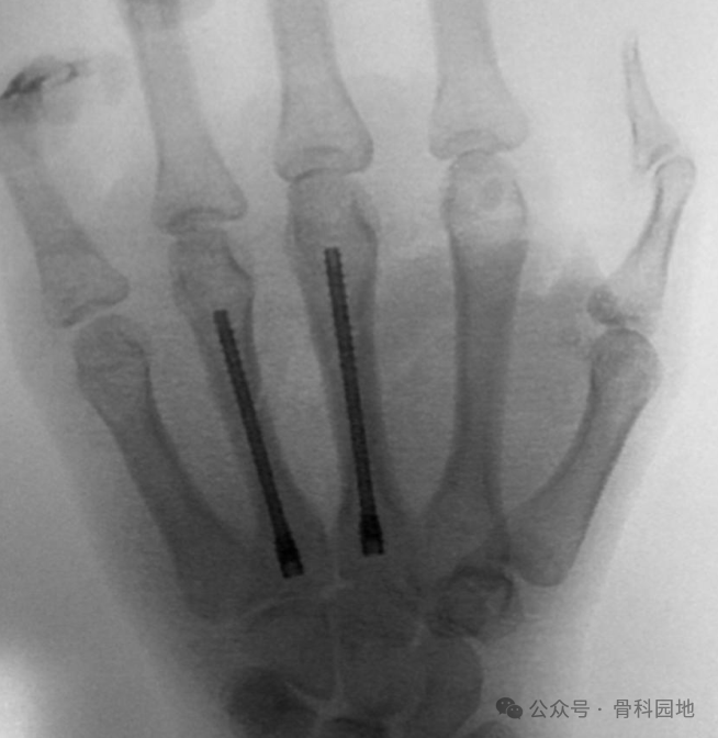 Antegrade Intramedullary Screw Fixation for Metacarpal Fractures: A Novel Technique