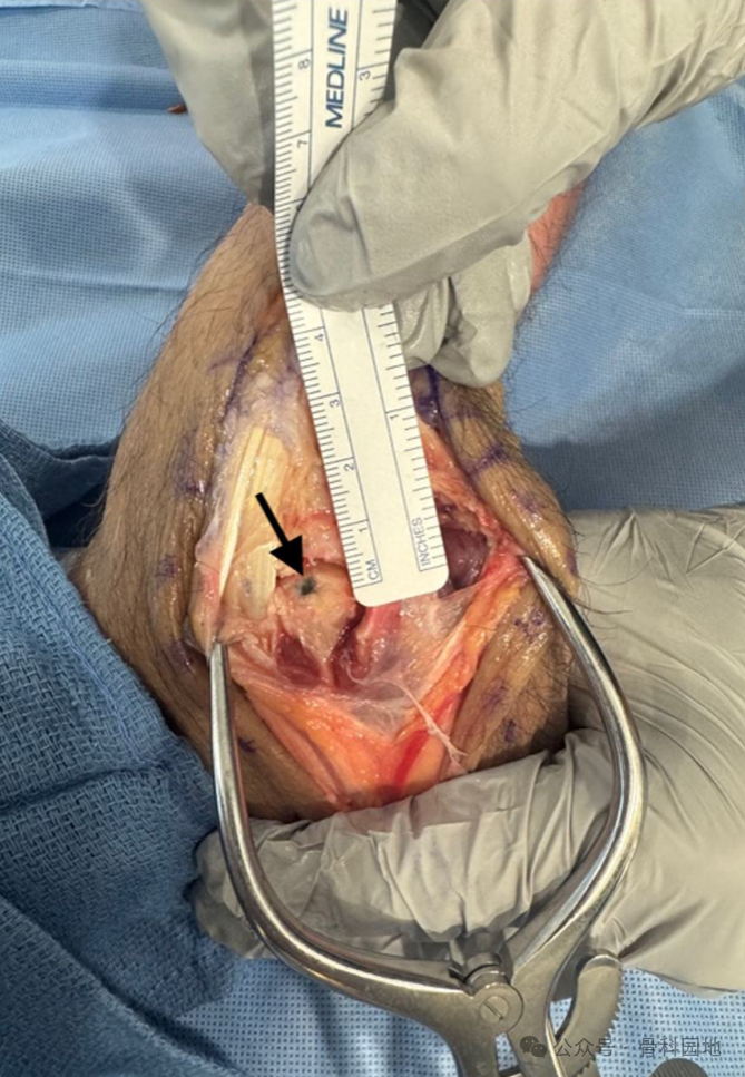 Antegrade Intramedullary Screw Fixation for Metacarpal Fractures: A Novel Technique
