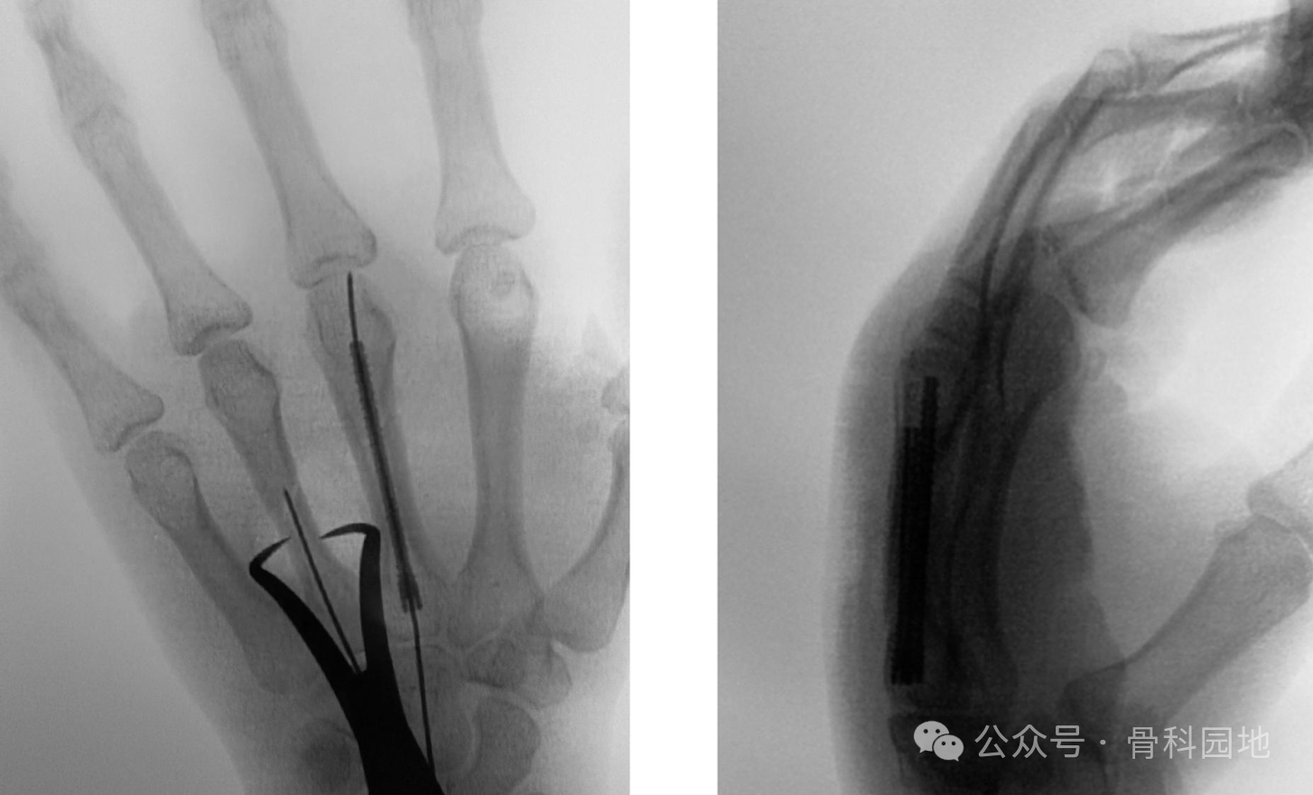Antegrade Intramedullary Screw Fixation for Metacarpal Fractures: A Novel Technique