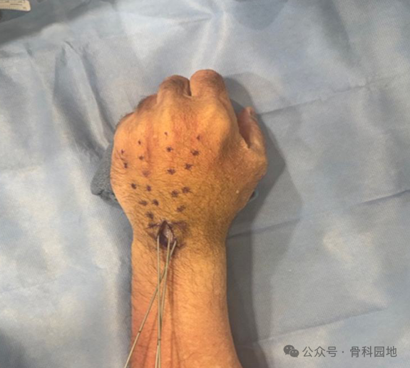 Antegrade Intramedullary Screw Fixation for Metacarpal Fractures: A Novel Technique
