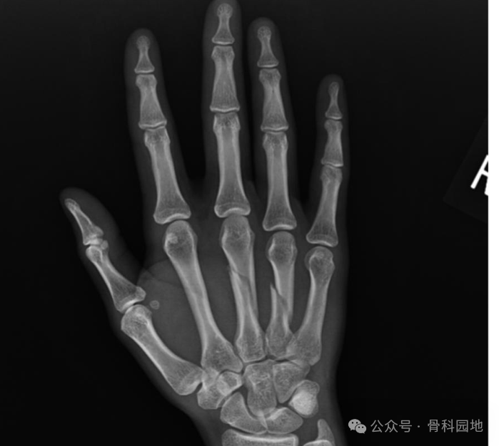 antegrade intramedullary screw fixation for metacarpal fractures a novel technique-2