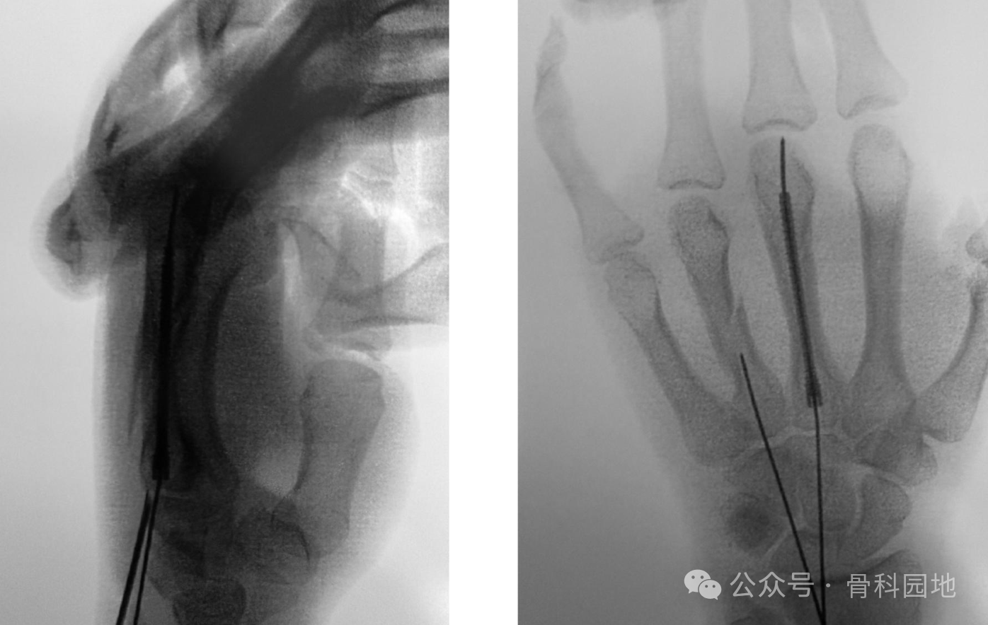 antegrade intramedullary screw fixation for metacarpal fractures a novel technique-5